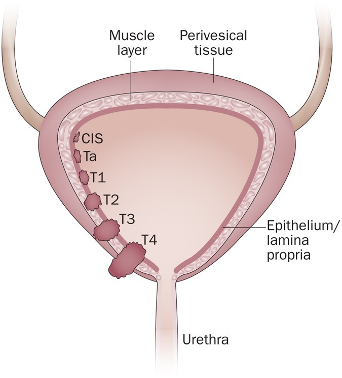 stages of bladder cancer