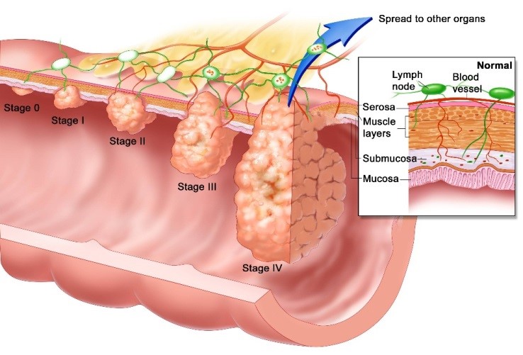 Esophageal Biopsy