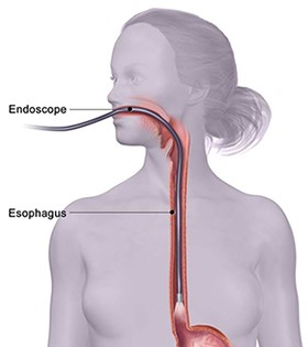 Esophageal Endoscopy
