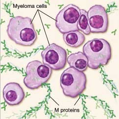 Multiple Myeloma