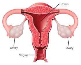 Ovarian Cancer