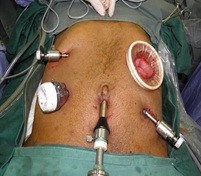 Gastric Laparoscopy