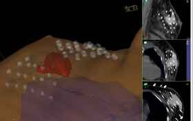 High Dose Rate (HDR) Brachytherapy 