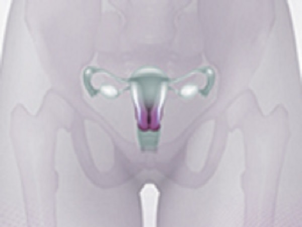 Cervical Cancer Screening Thumbnail